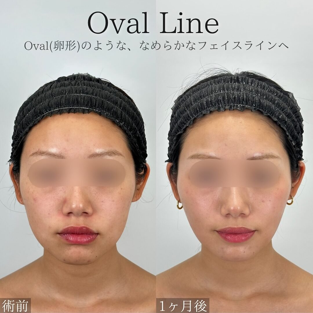 脂肪吸引注射の症例写真（術前・術後）