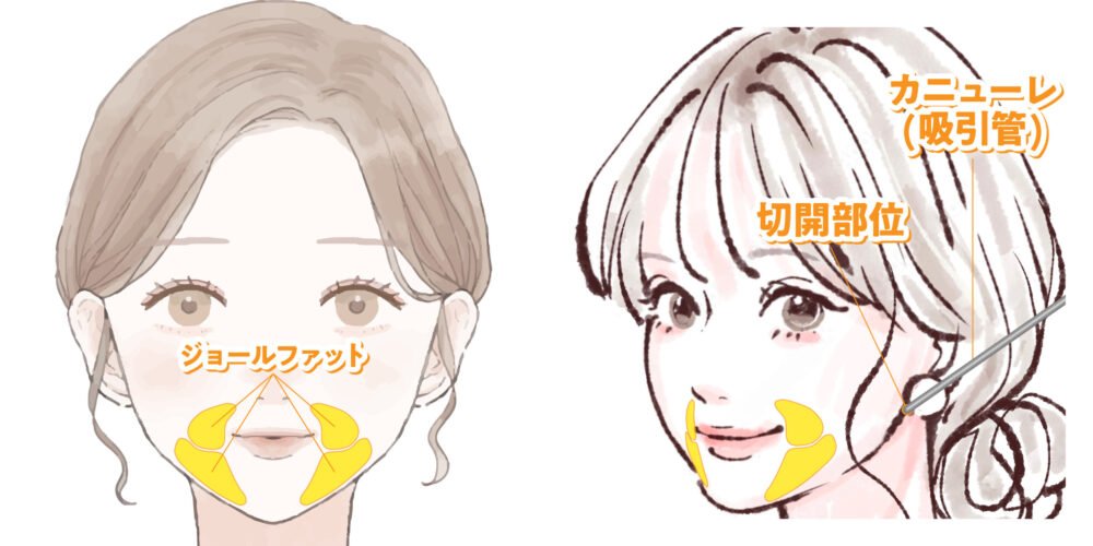 小顔脂肪吸引の解説画像