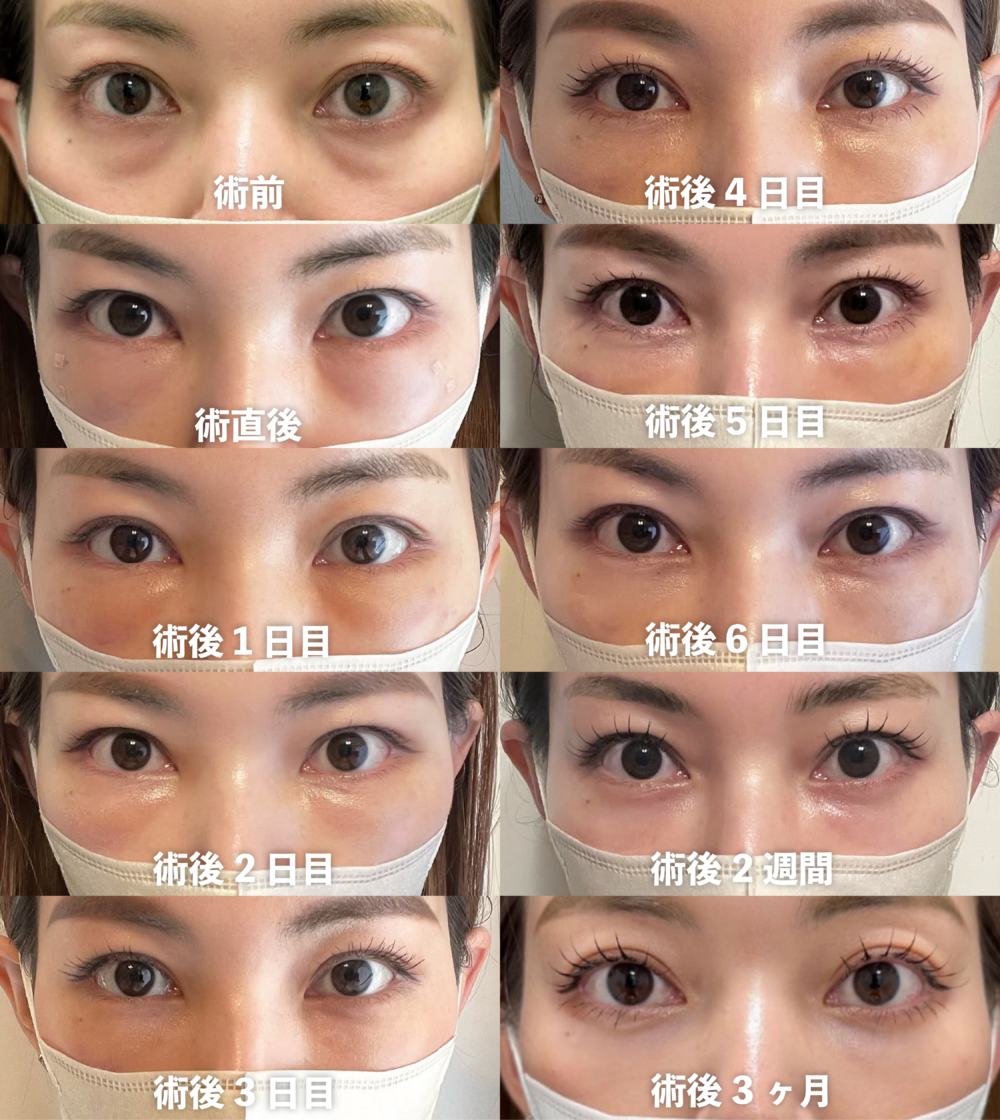 裏ハムラ法の症例写真（術前・術後）