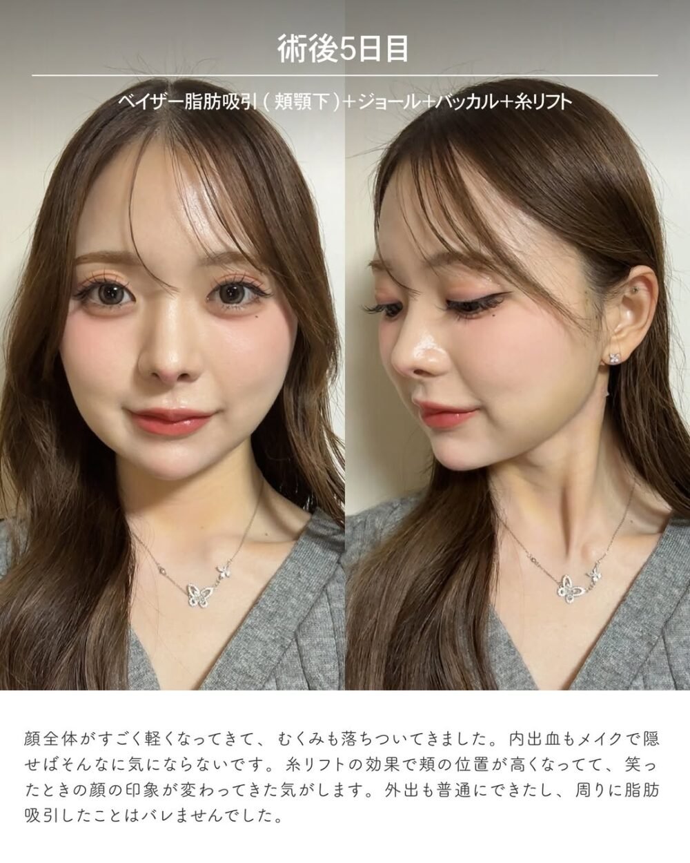 エンブレイスRFの症例写真