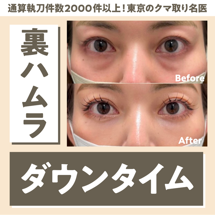 【医師監修】裏ハムラ法のダウンタイムは？脱脂との違いや経過を症例写真で解説〈東京・六本木のFirst Clinic〉