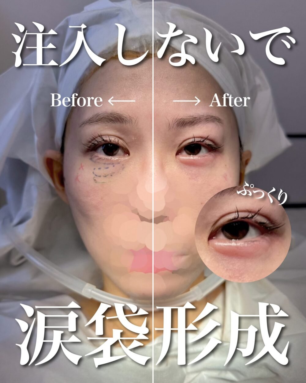 切らない涙袋形成の症例写真