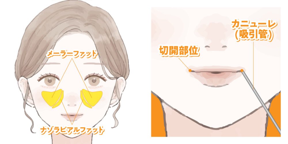 小顔脂肪吸引の解説画像
