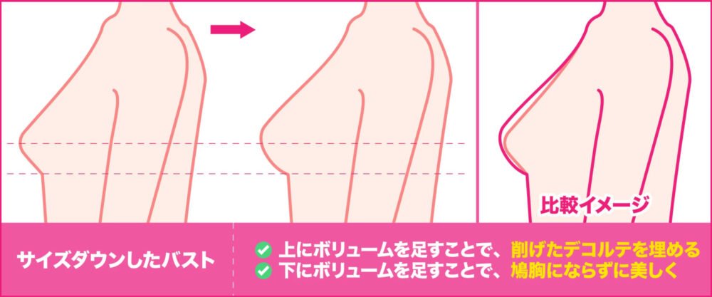 脂肪豊胸の解説