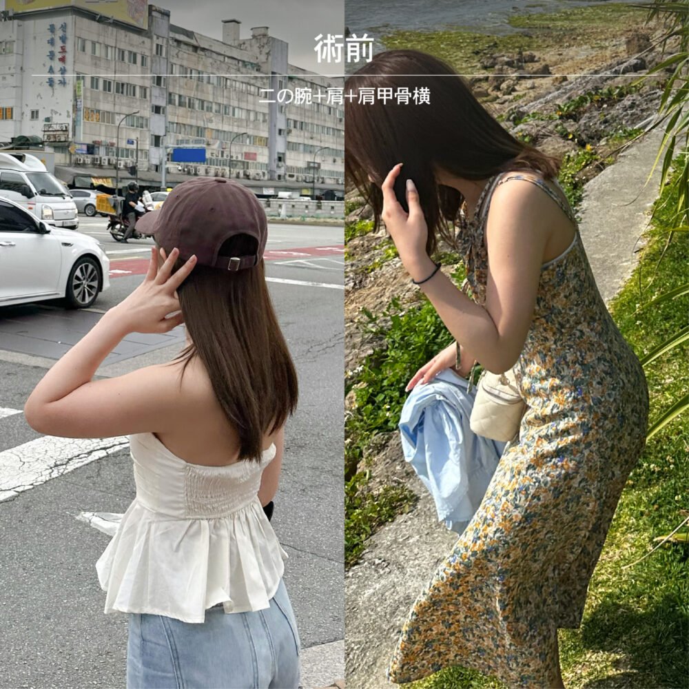 二の腕脂肪吸引のダウンタイム経過の症例写真