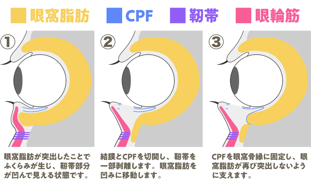 裏ハムラによる目元若返りの解説画像