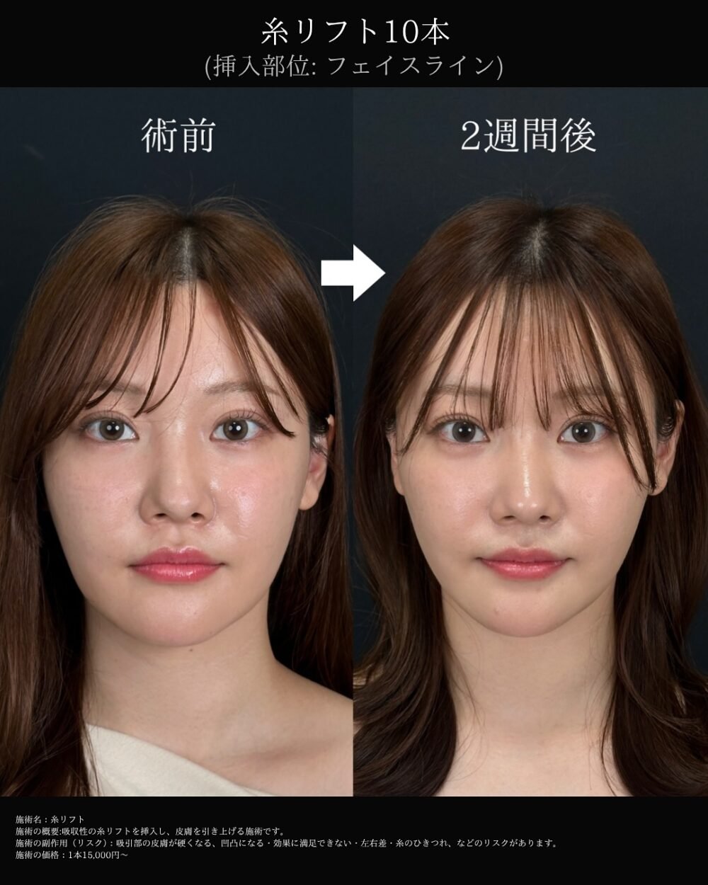 糸リフトの症例写真