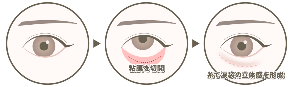 クマ取りの術式図解