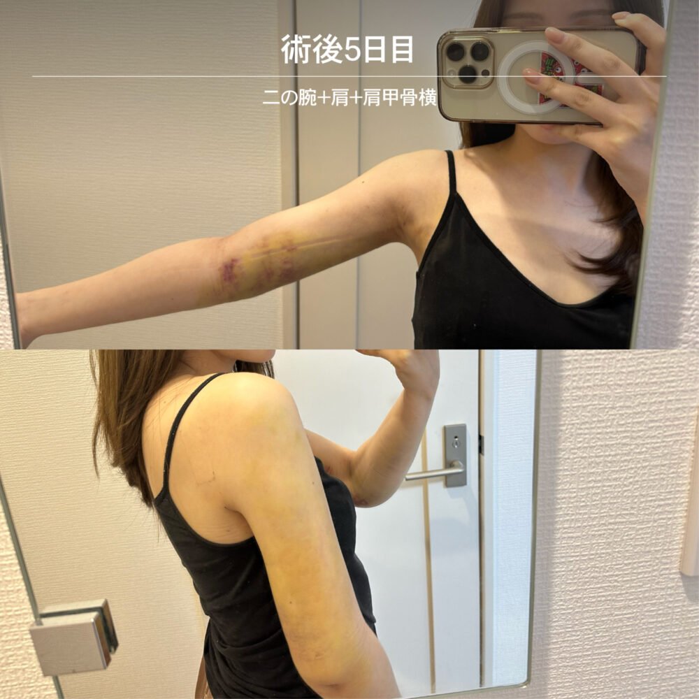二の腕脂肪吸引のダウンタイム経過の症例写真