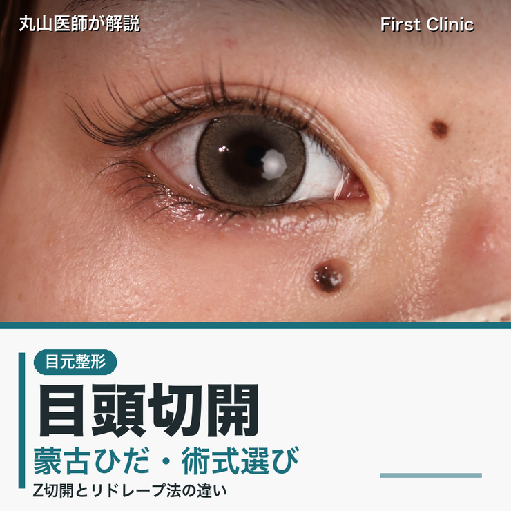 目頭切開とは？蒙古ひだ・Z切開とリドレープ法の違いを医師が解説
