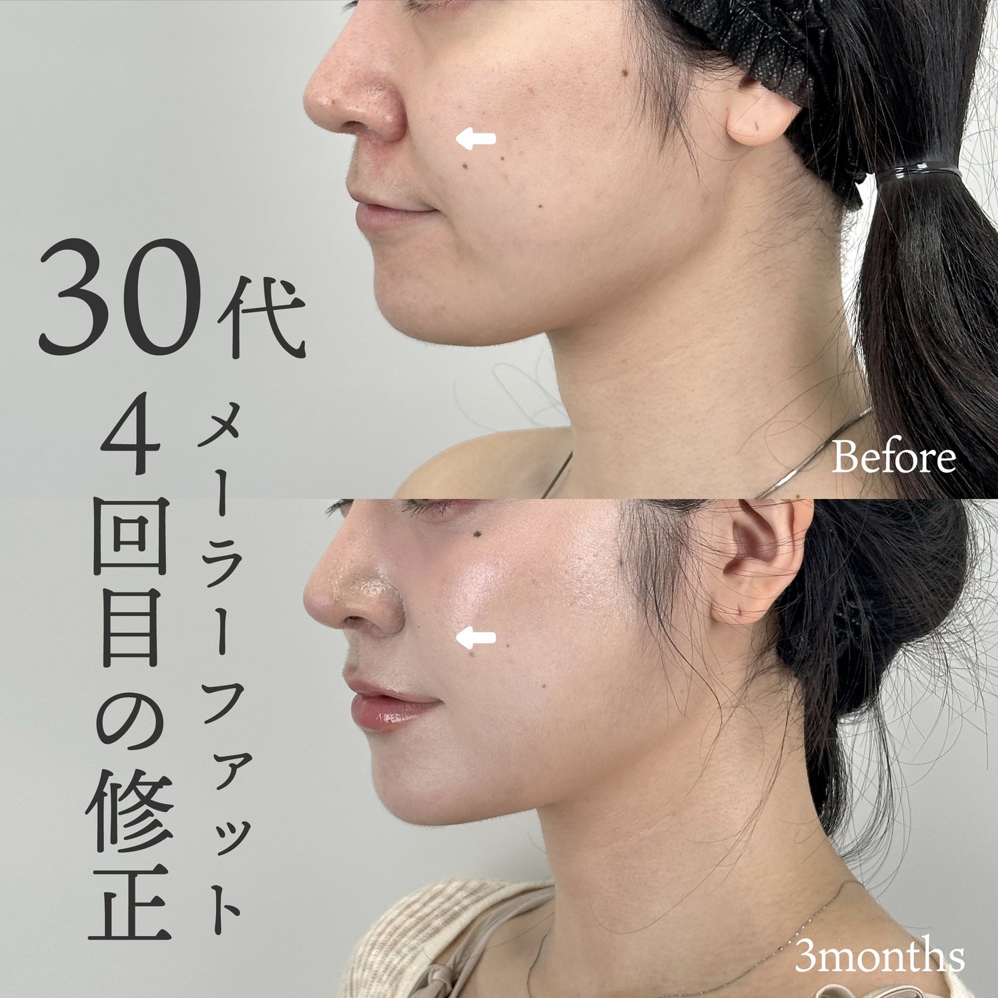 30代女性　他院修正