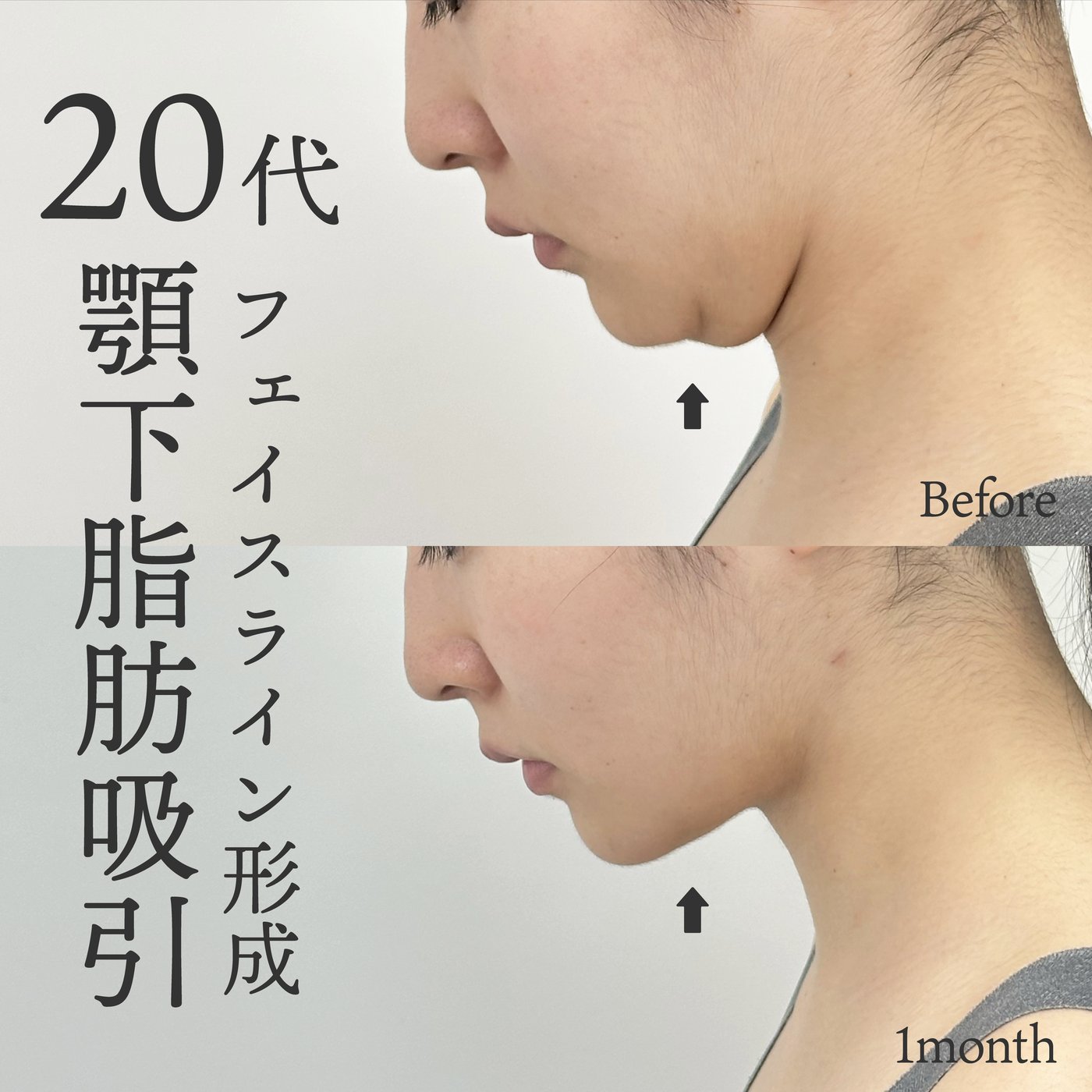 20代女性　顎下脂肪吸引