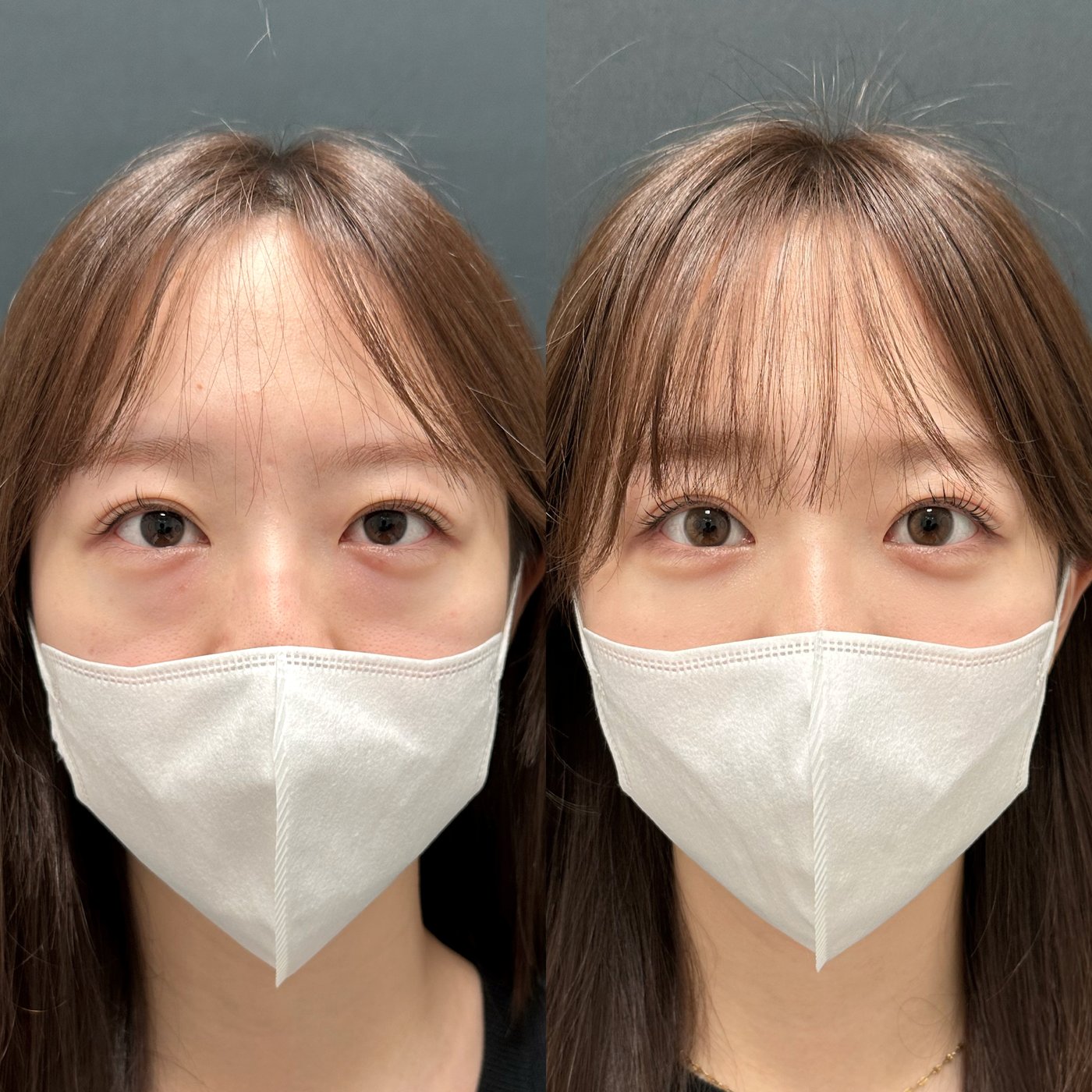 20代女性　クマ取り