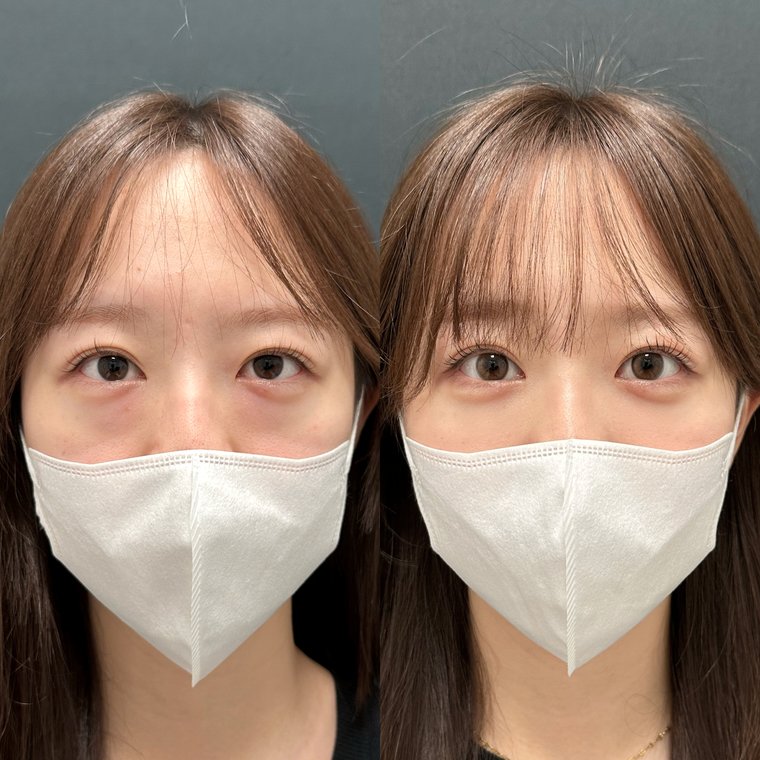 20代女性　クマ取り