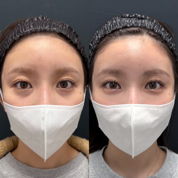 20代女性　クマ取り