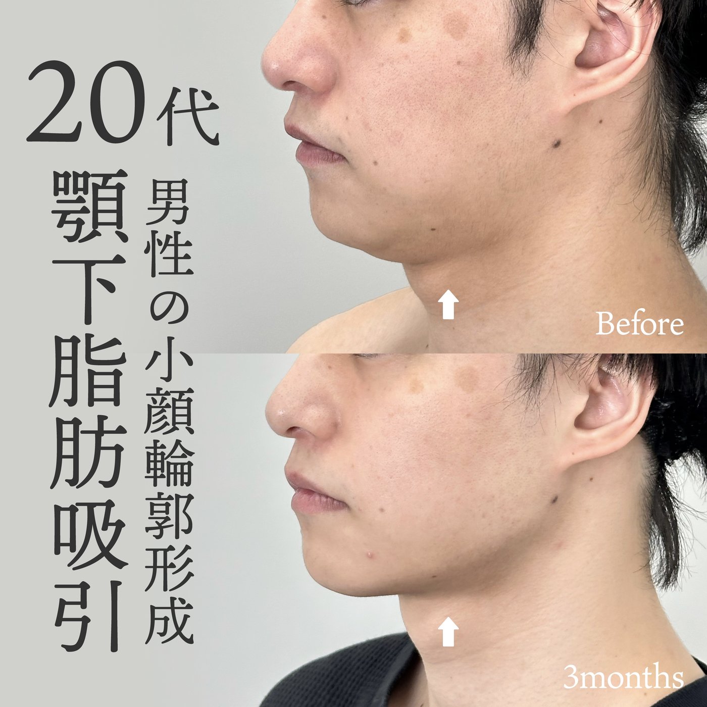 20代男性　初回手術