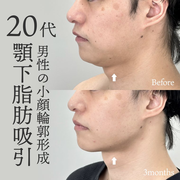 20代男性　初回手術