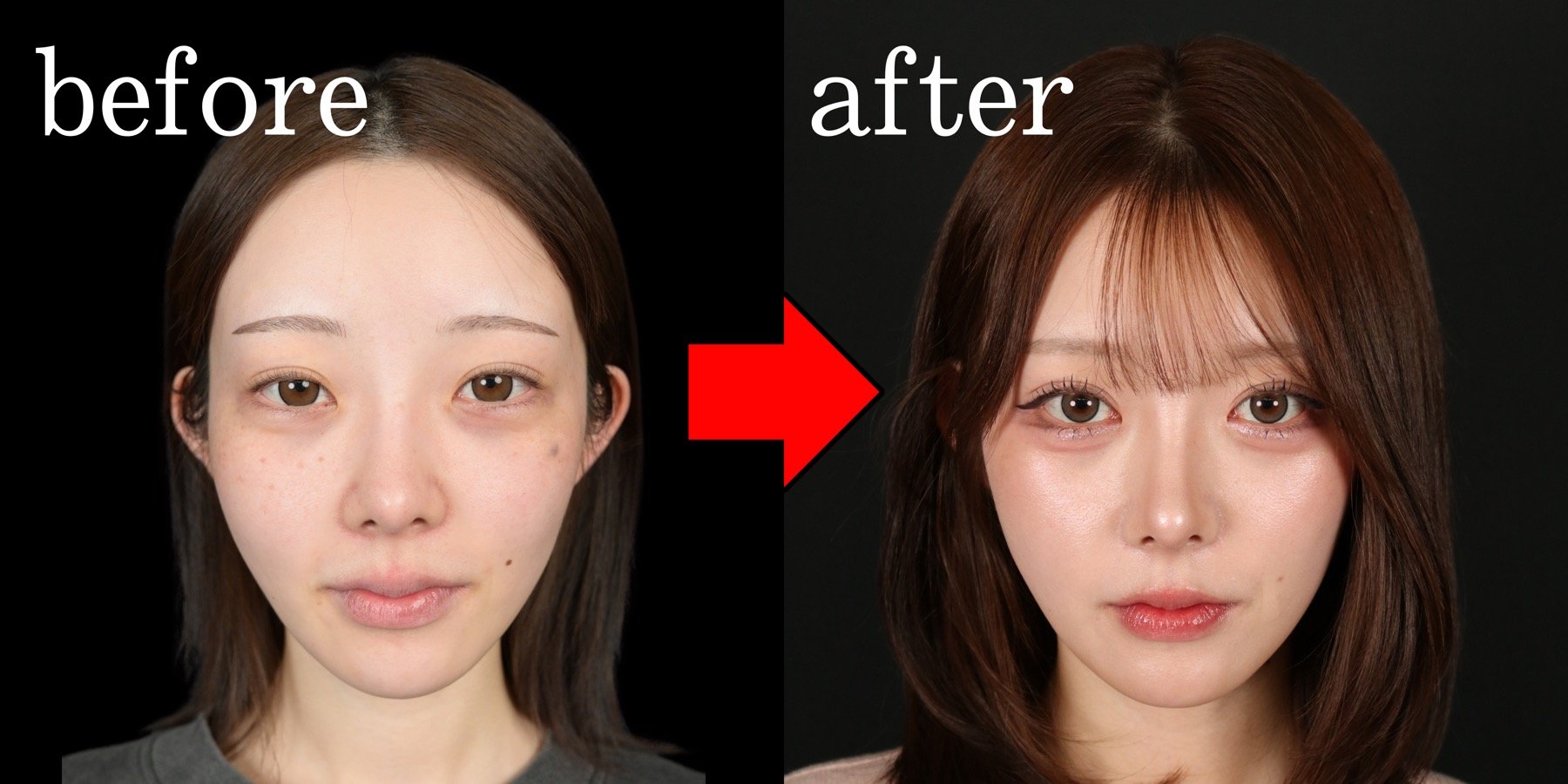 目頭切開のBefore After全顔比較