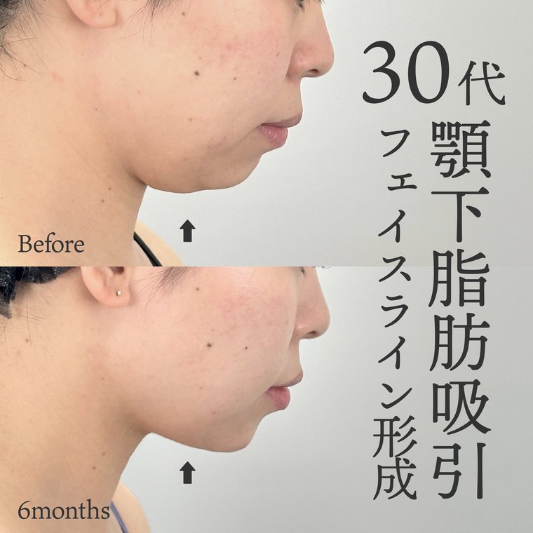 30代女性　顎先形成
