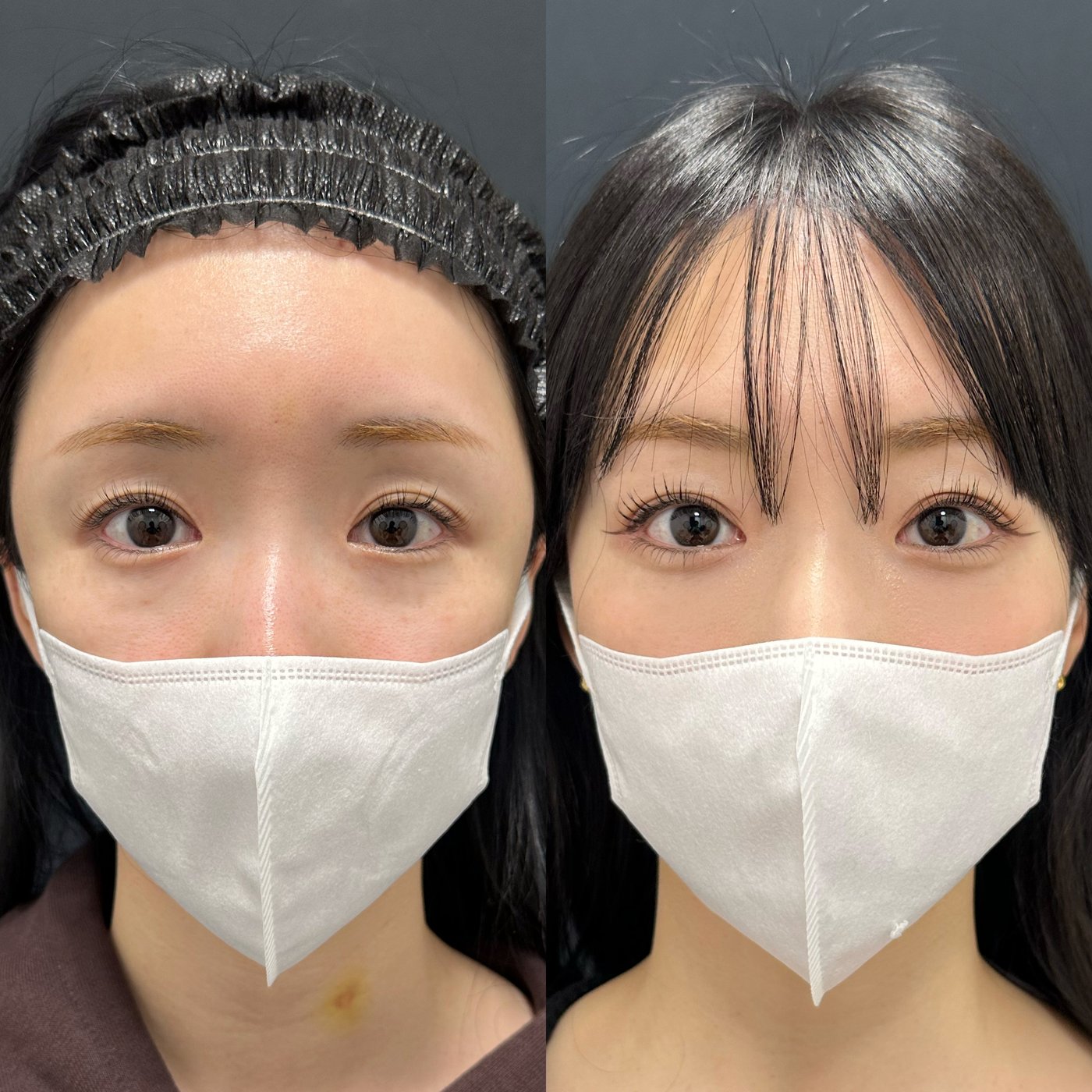 30代女性　他院修正