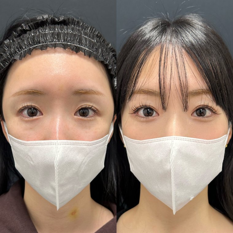 30代女性　他院修正