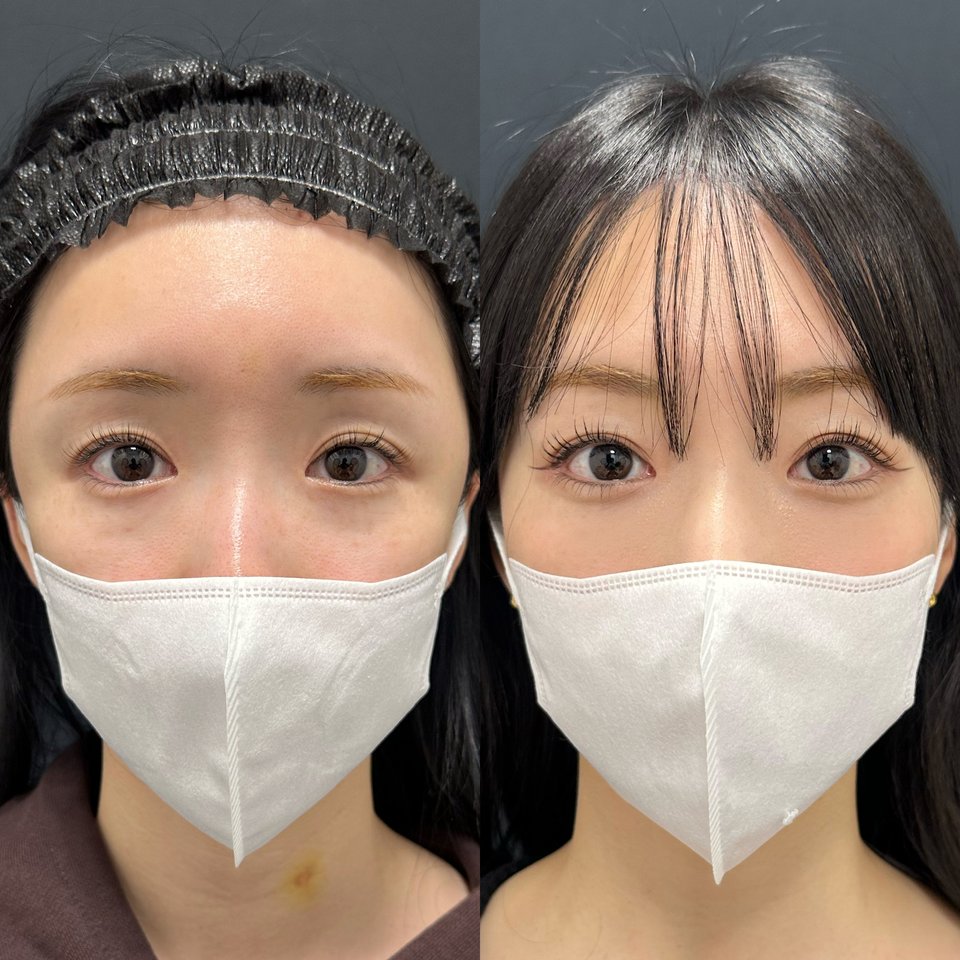30代女性　他院修正