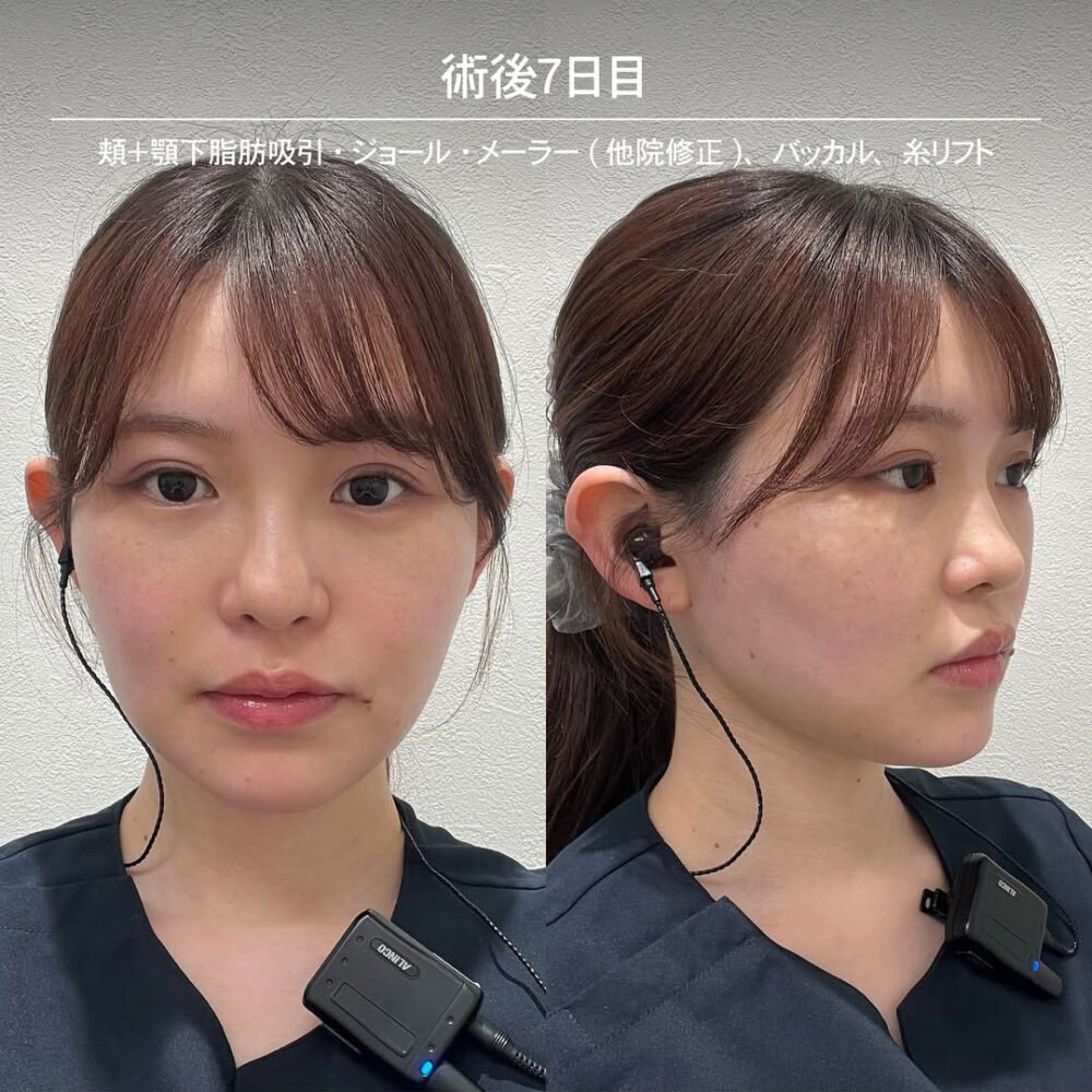 顔の脂肪吸引のダウンタイム経過の症例写真