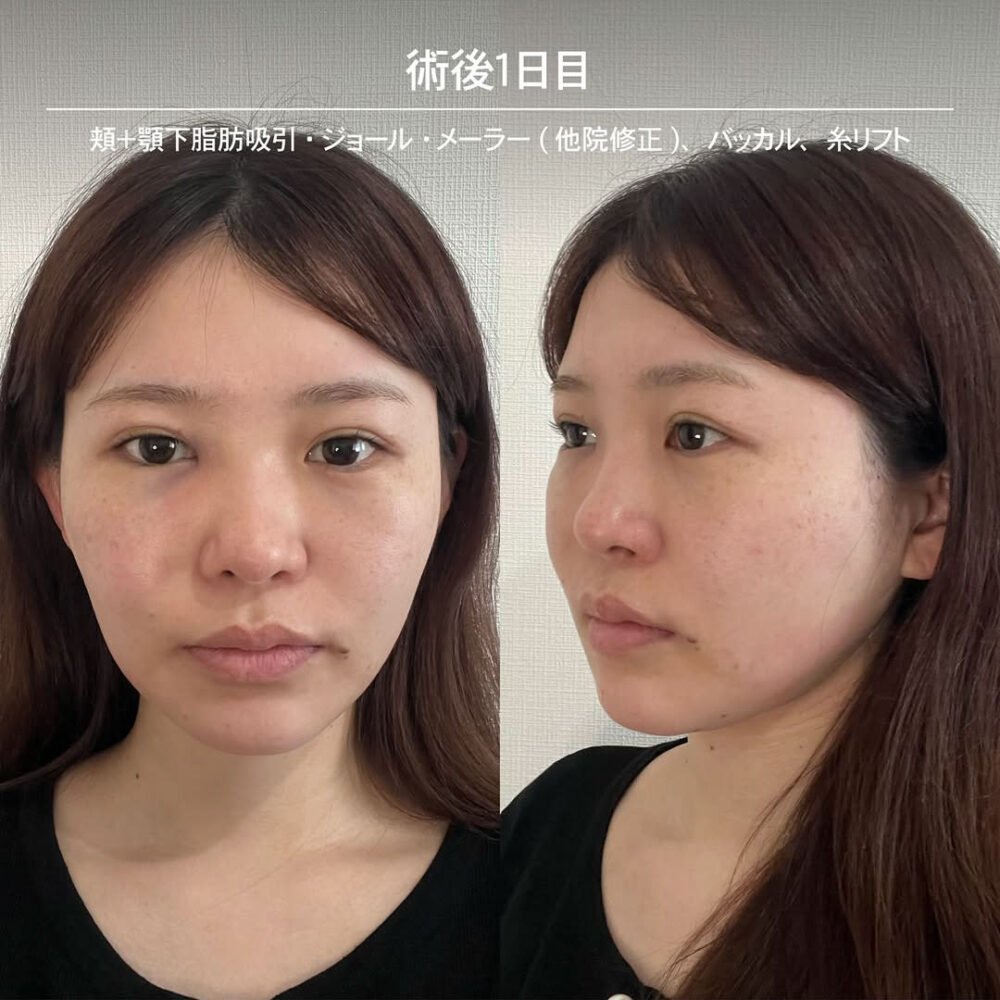 顔の脂肪吸引のダウンタイム経過の症例写真