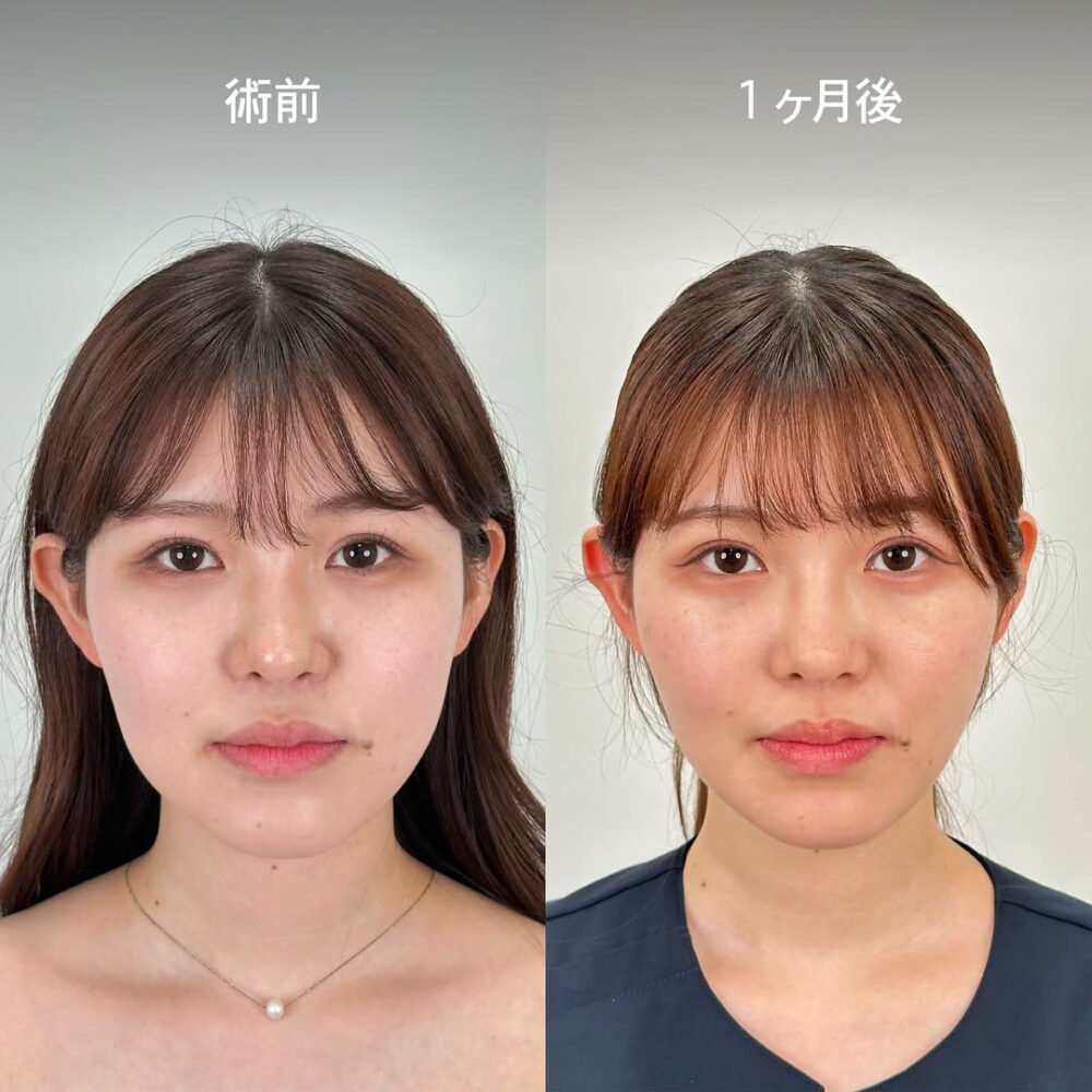 顔の脂肪吸引のダウンタイム経過の症例写真