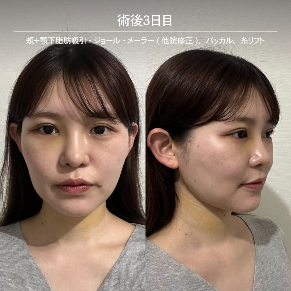 顔の脂肪吸引のダウンタイム経過の症例写真