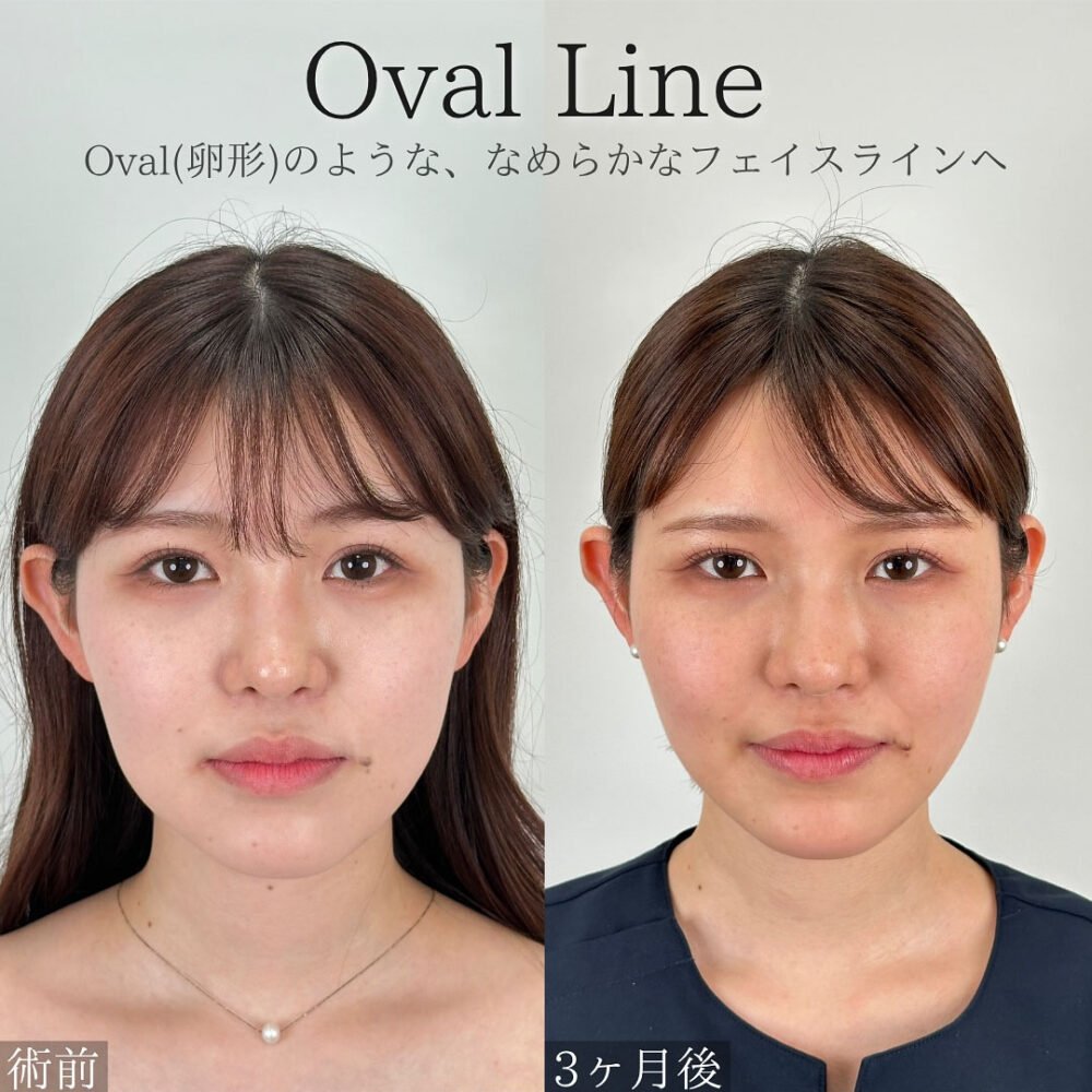 顔の脂肪吸引のダウンタイム経過の症例写真