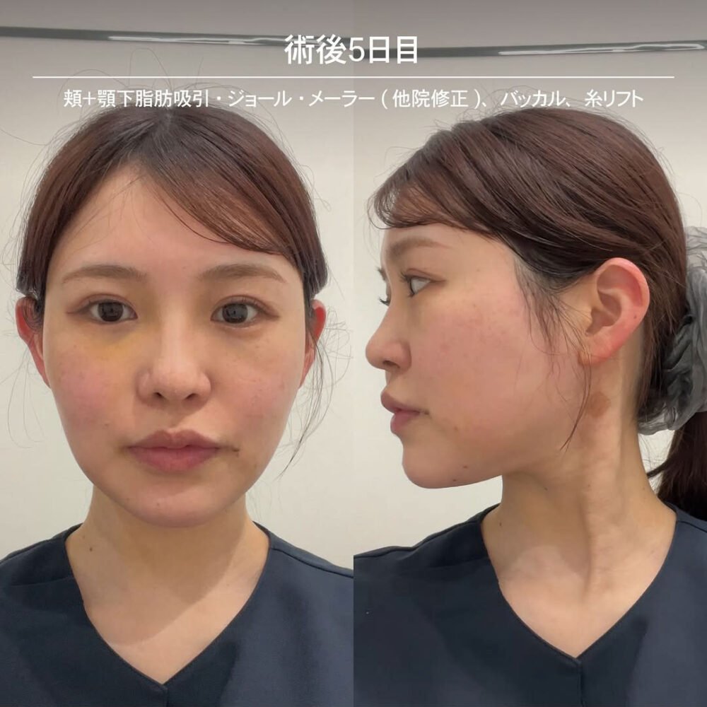 顔の脂肪吸引のダウンタイム経過の症例写真
