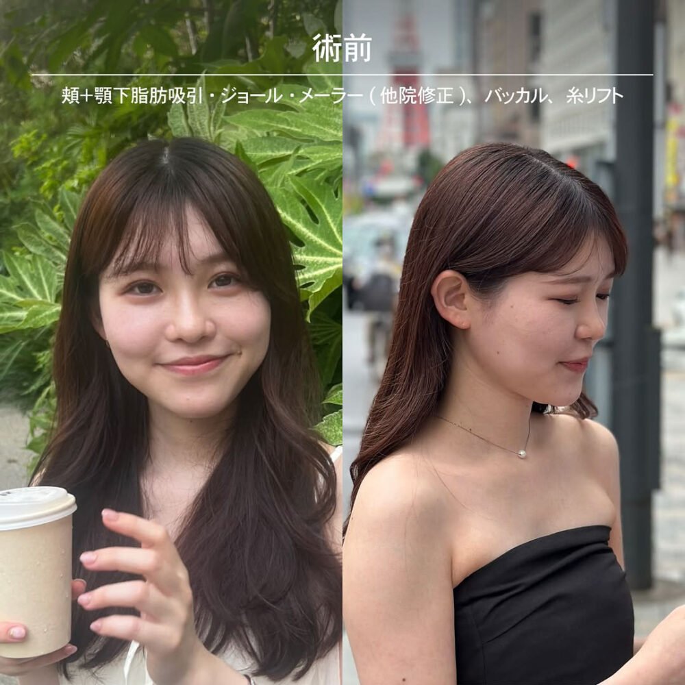 顔の脂肪吸引のダウンタイム経過の症例写真