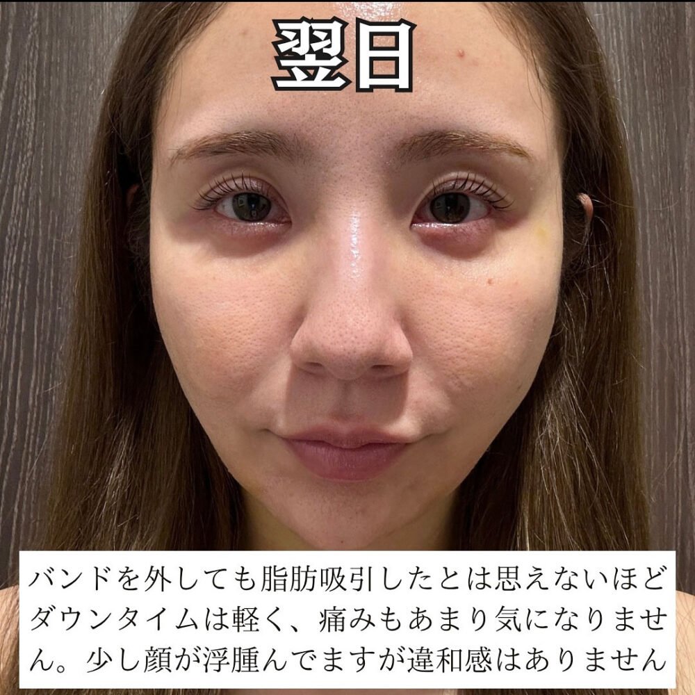 顔の脂肪吸引のダウンタイム経過の症例写真