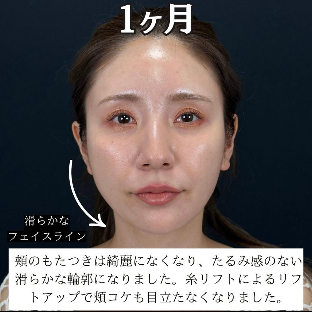 顔の脂肪吸引のダウンタイム経過の症例写真