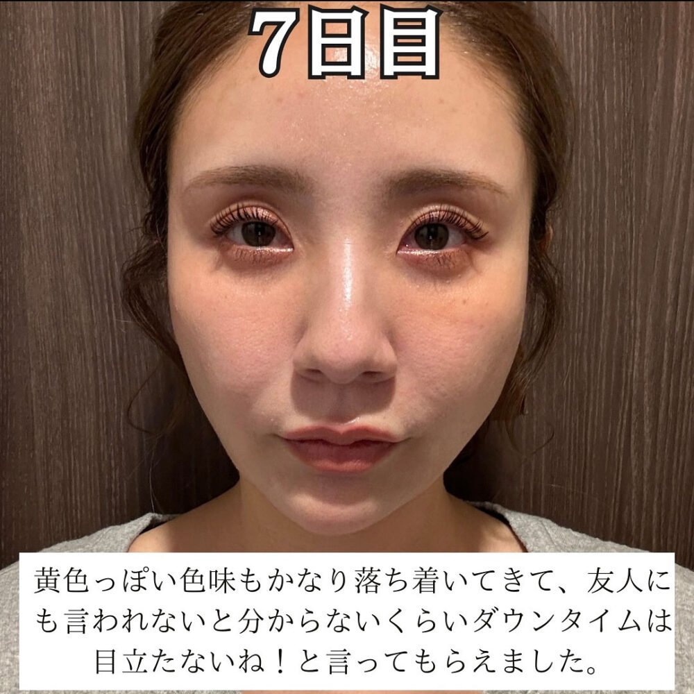 顔の脂肪吸引のダウンタイム経過の症例写真