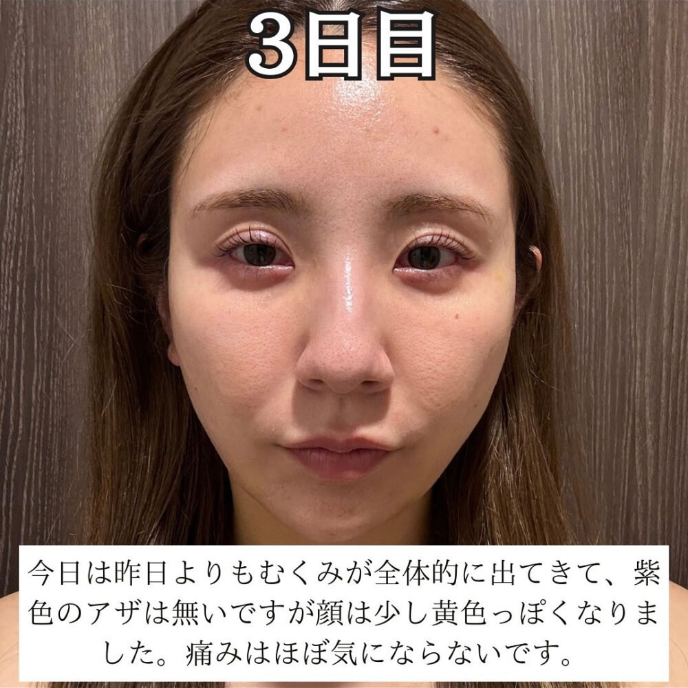 顔の脂肪吸引のダウンタイム経過の症例写真