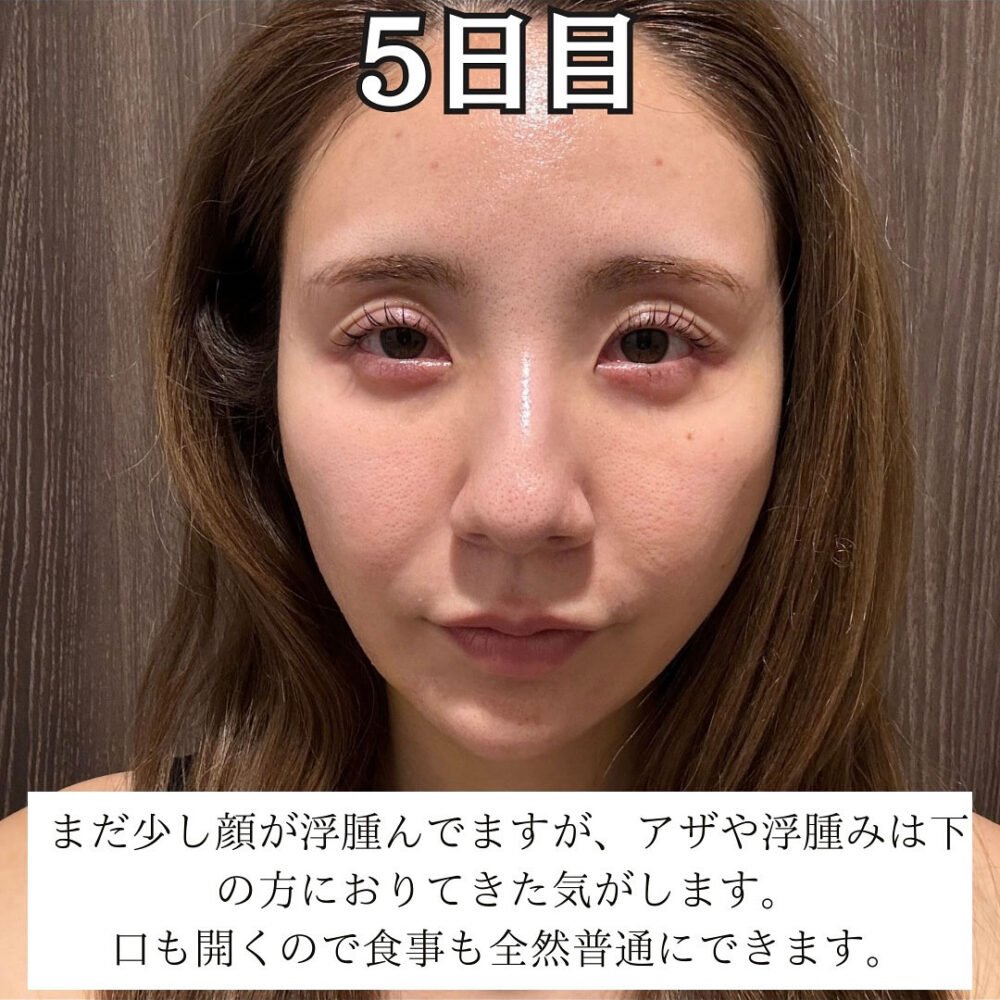 顔の脂肪吸引のダウンタイム経過の症例写真