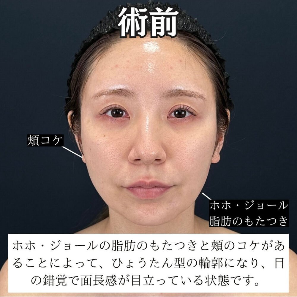 顔の脂肪吸引のダウンタイム経過の症例写真