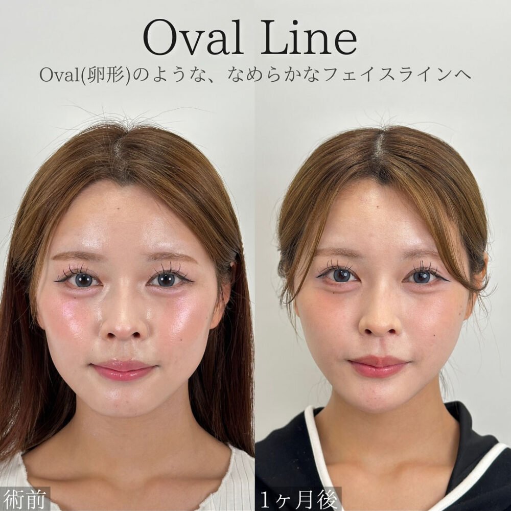 顔の脂肪吸引のダウンタイム経過の症例写真