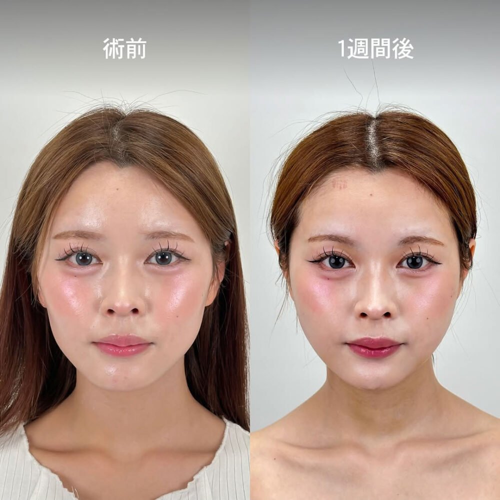 顔の脂肪吸引のダウンタイム経過の症例写真