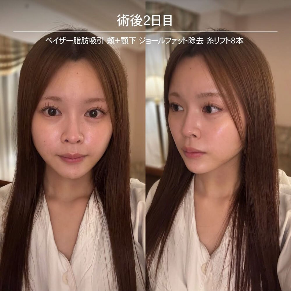 顔の脂肪吸引のダウンタイム経過の症例写真