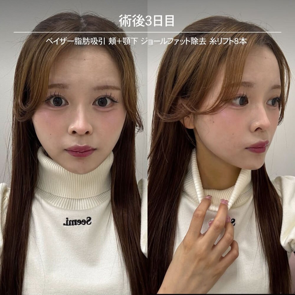 顔の脂肪吸引のダウンタイム経過の症例写真