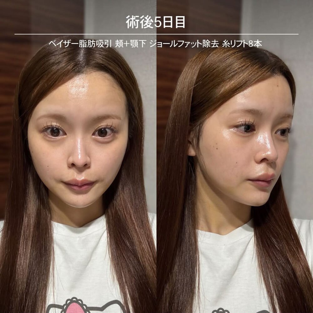 顔の脂肪吸引のダウンタイム経過の症例写真