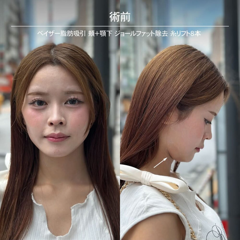 顔の脂肪吸引のダウンタイム経過の症例写真