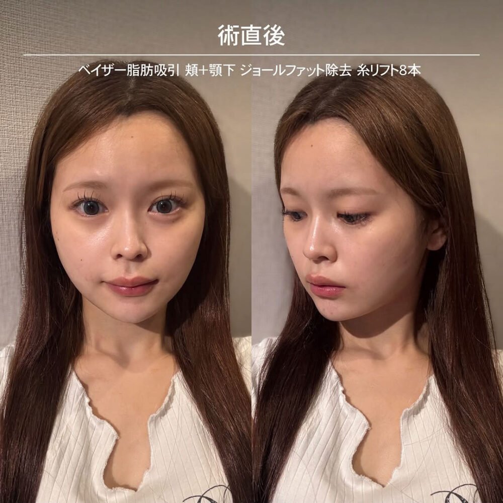顔の脂肪吸引のダウンタイム経過の症例写真
