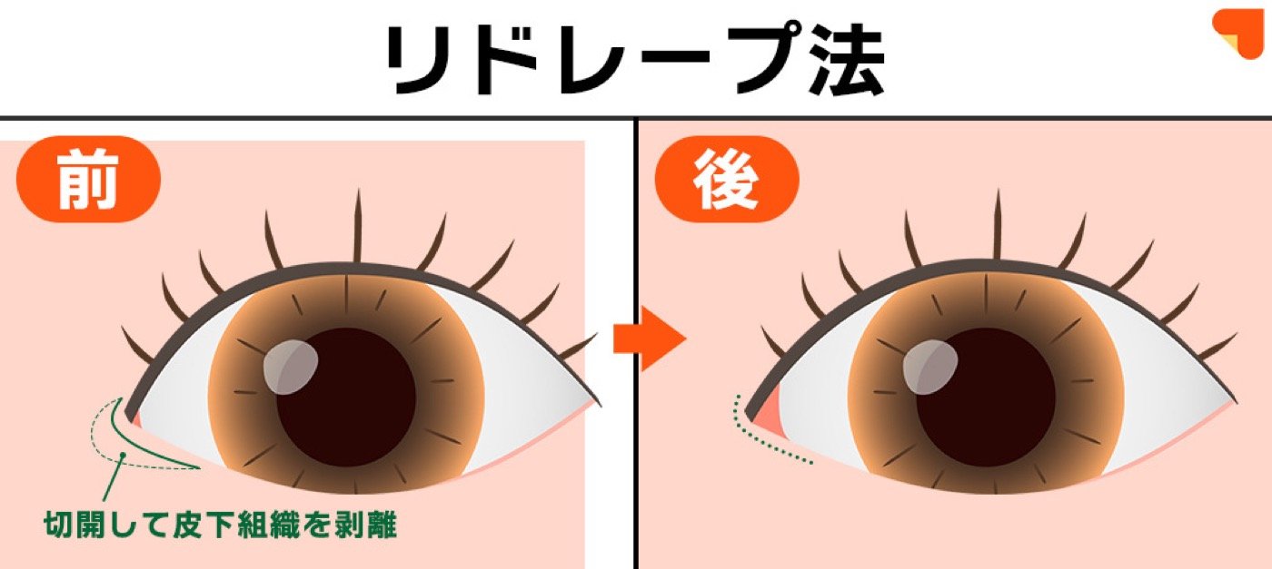 リドレープ法の切開デザインを示した図解