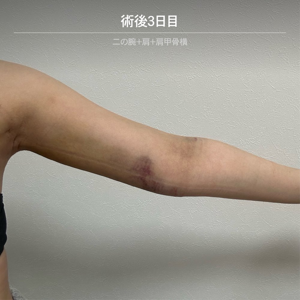ダウンタイム経過_二の腕_2-17（復元・旧HP）