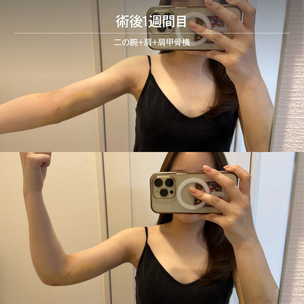 ダウンタイム経過_二の腕_2-19（復元・旧HP）