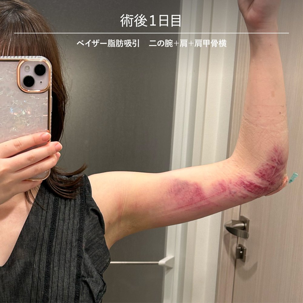 ダウンタイム経過_二の腕-08（復元・旧HP）